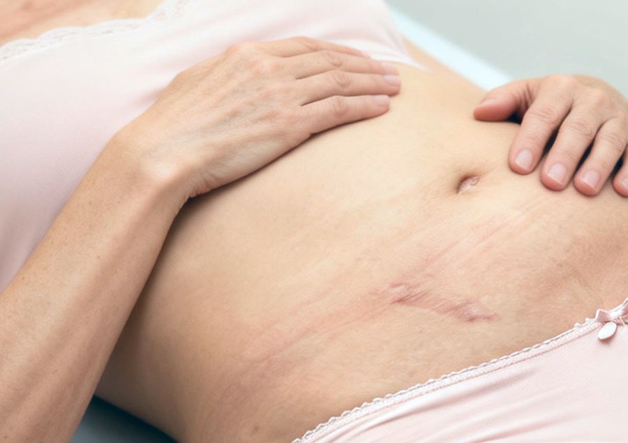 Comprendre le rôle des adhérences fasciales après chirurgie